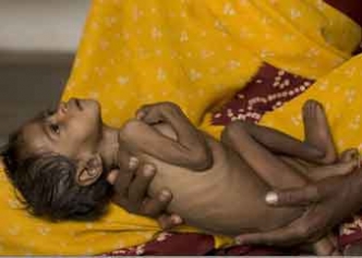 भानुमति के पिटारे से फिर निकला कुपोषण का जिन्न